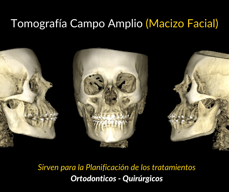 1.Amplio