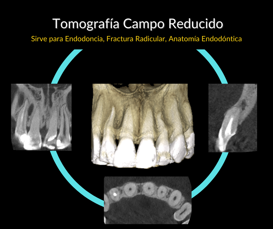 3.Reducido.