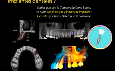 Deseo ponerme implantes, ¿cuál es el procedimiento?